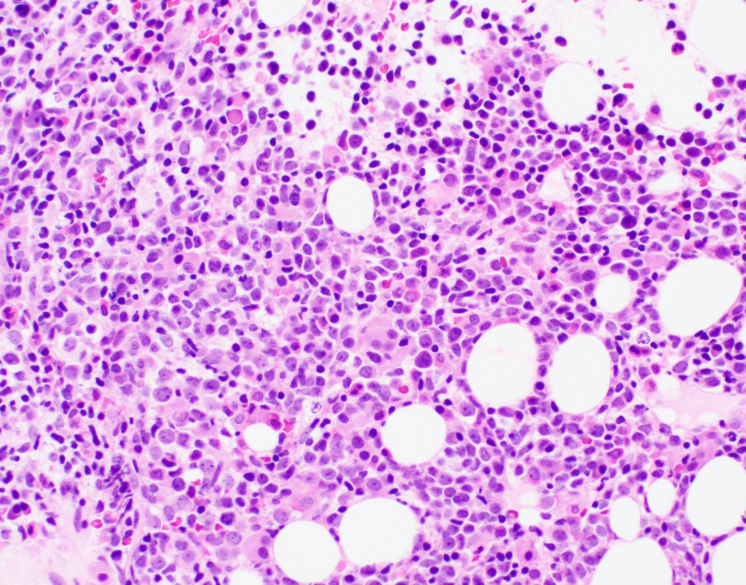 Hypercellular marrow with increased blasts