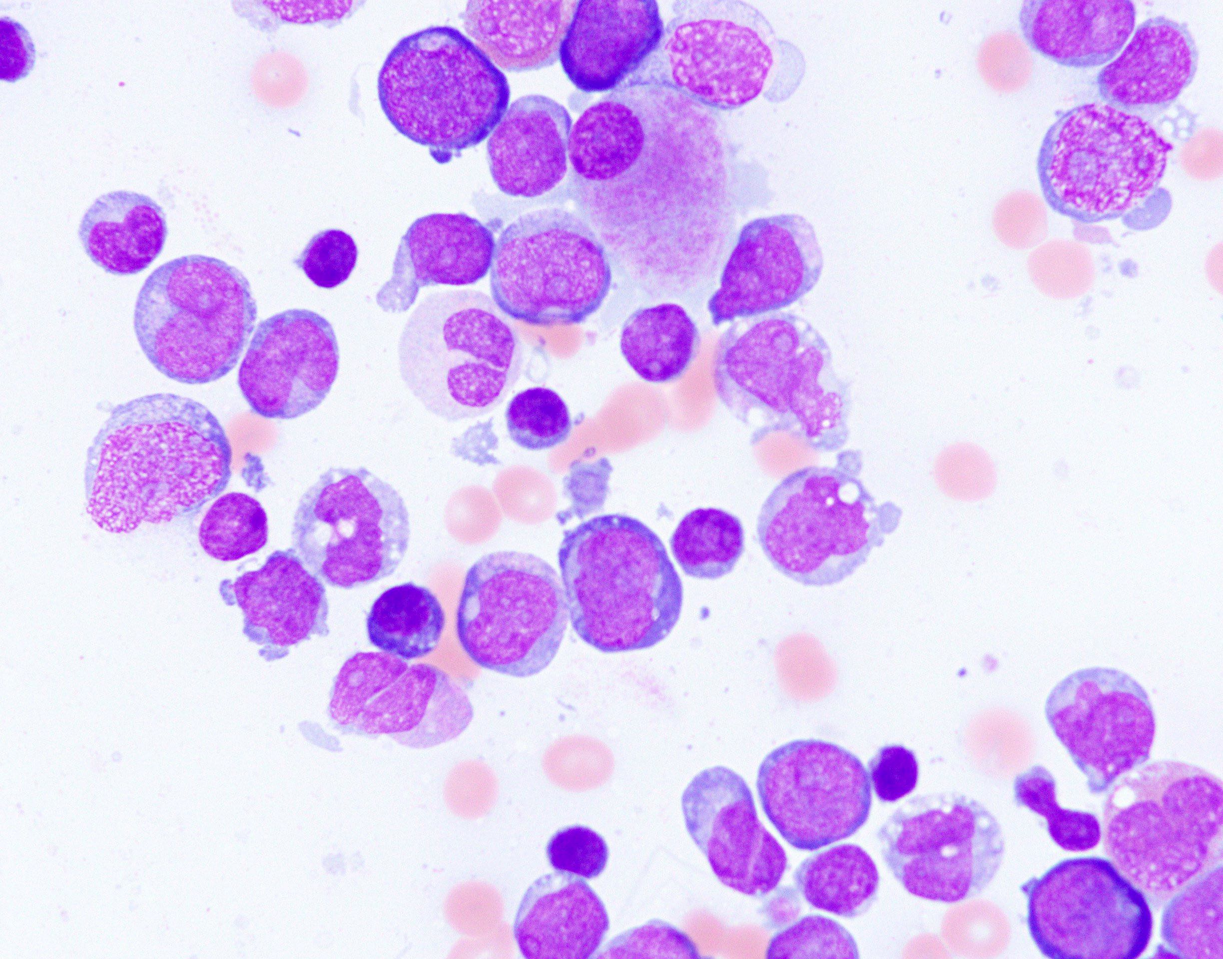 Aspirate with hypolobated mega