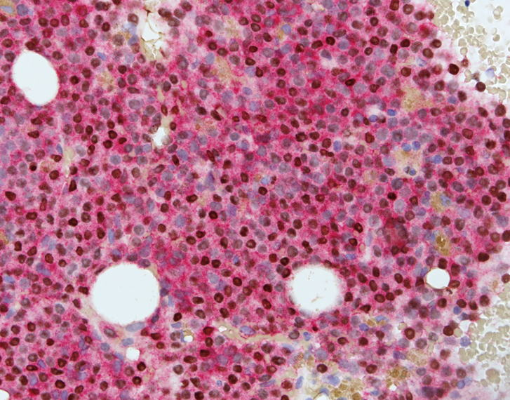 TCF4 / CD123 dual color stain in bone marrow