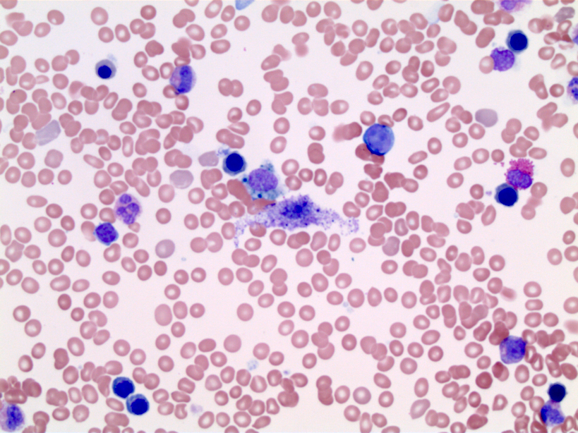 Aspirate with mast cells
