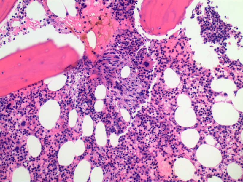 Marrow mast cell cluster