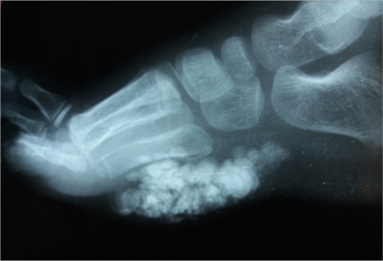 Calcified lesion, foot