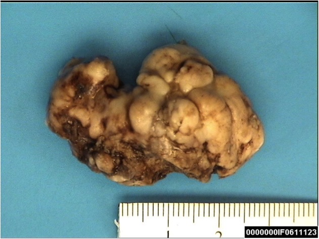 Osteoblastoma-like osteoma