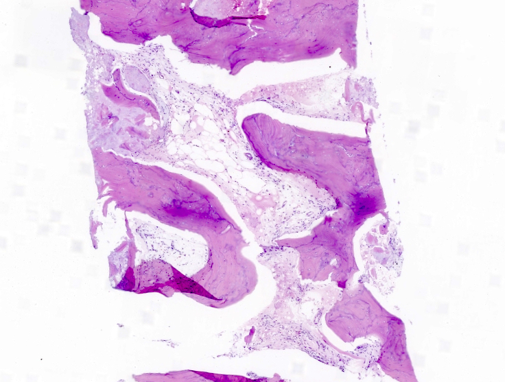Peritrabecular fibrosis