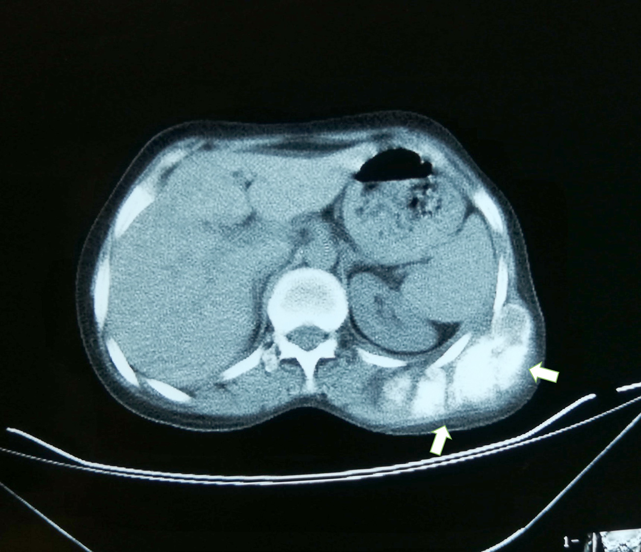 Parosteal osteosarcoma of rib