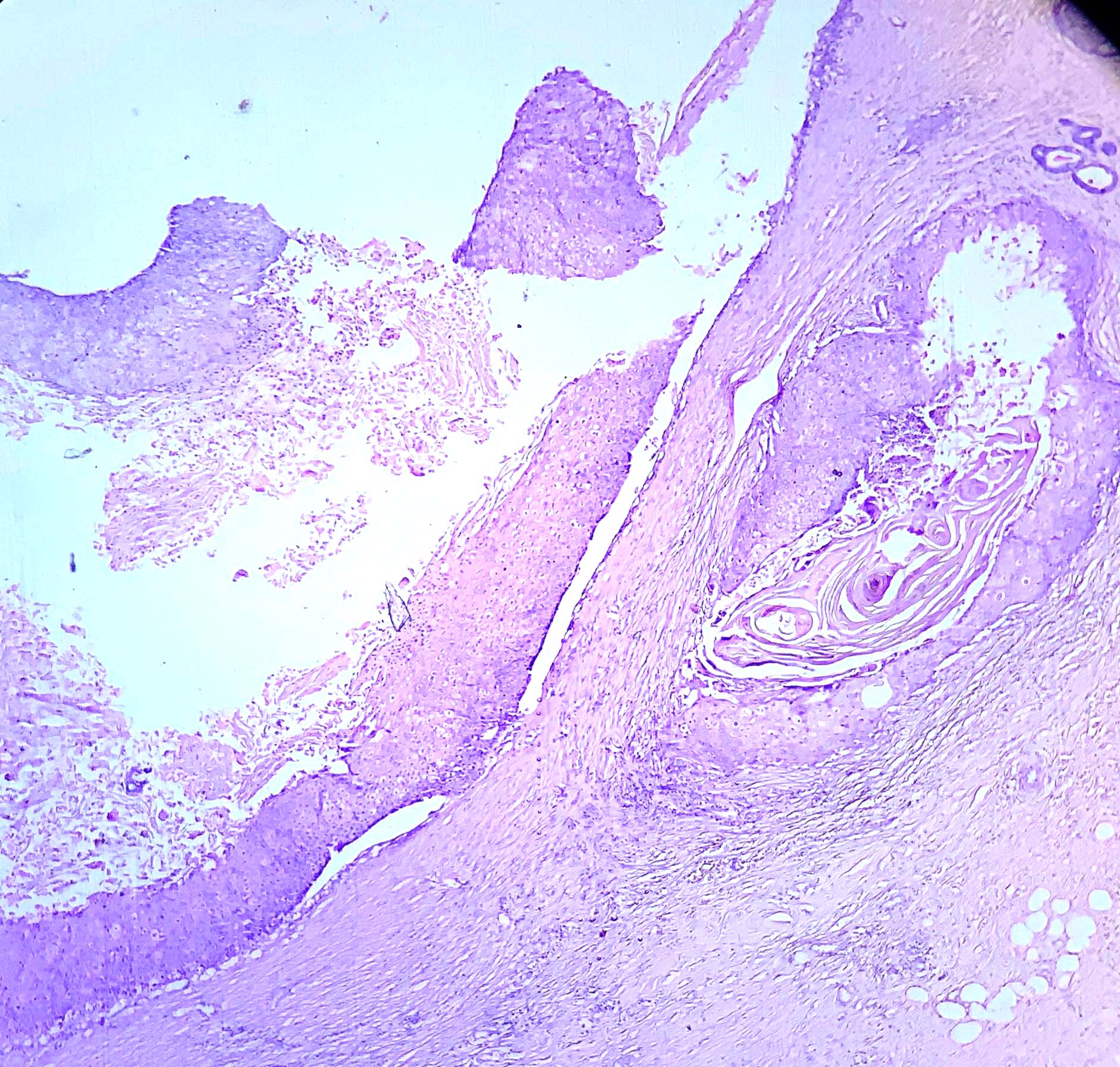 Cystic lesion with infiltration