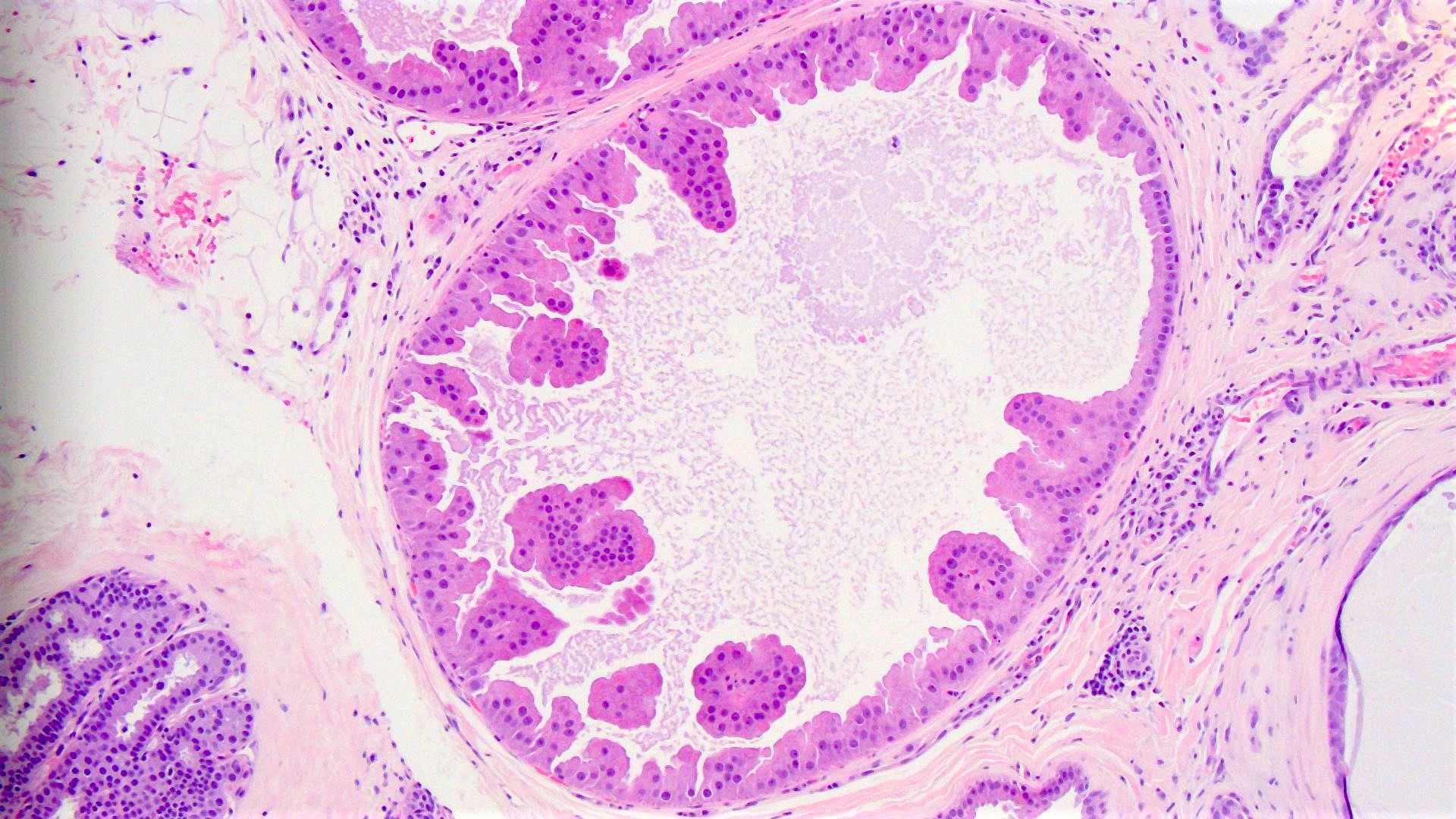 intraductal papilloma with extensive apocrine metaplasia