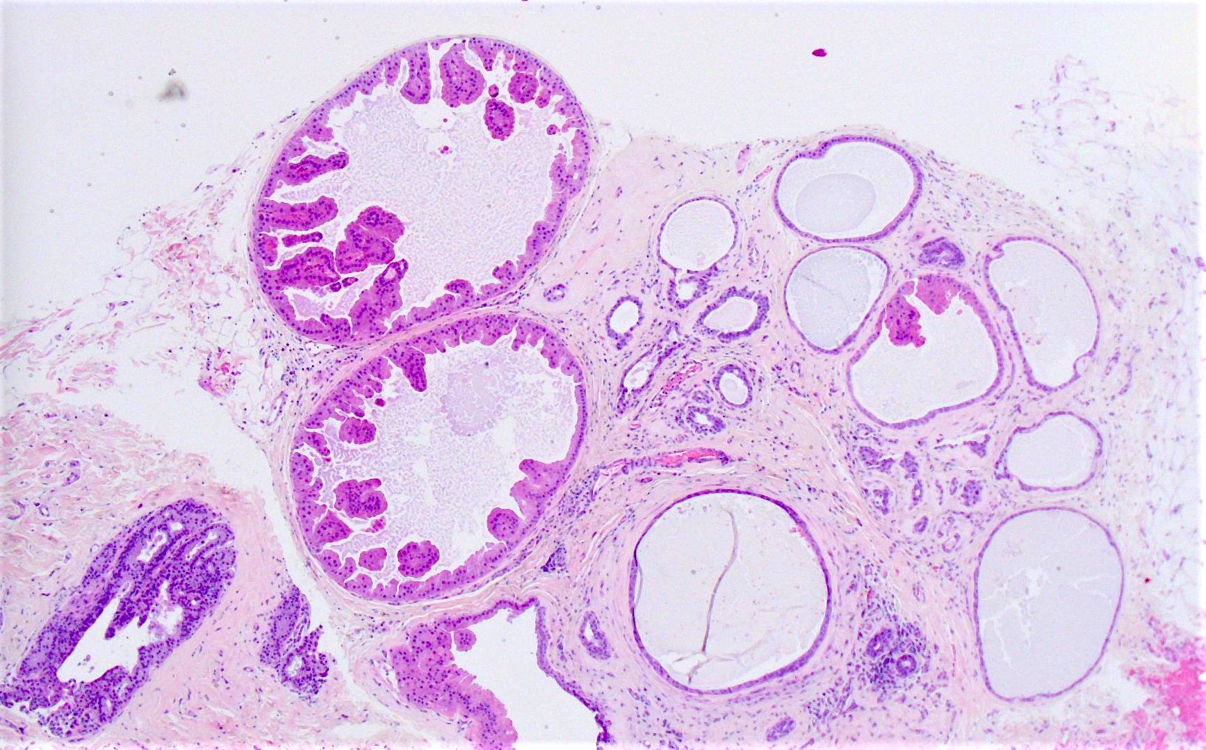 Papillary lesion with apocrine metaplasia - Papilloma with apocrine metaplasia