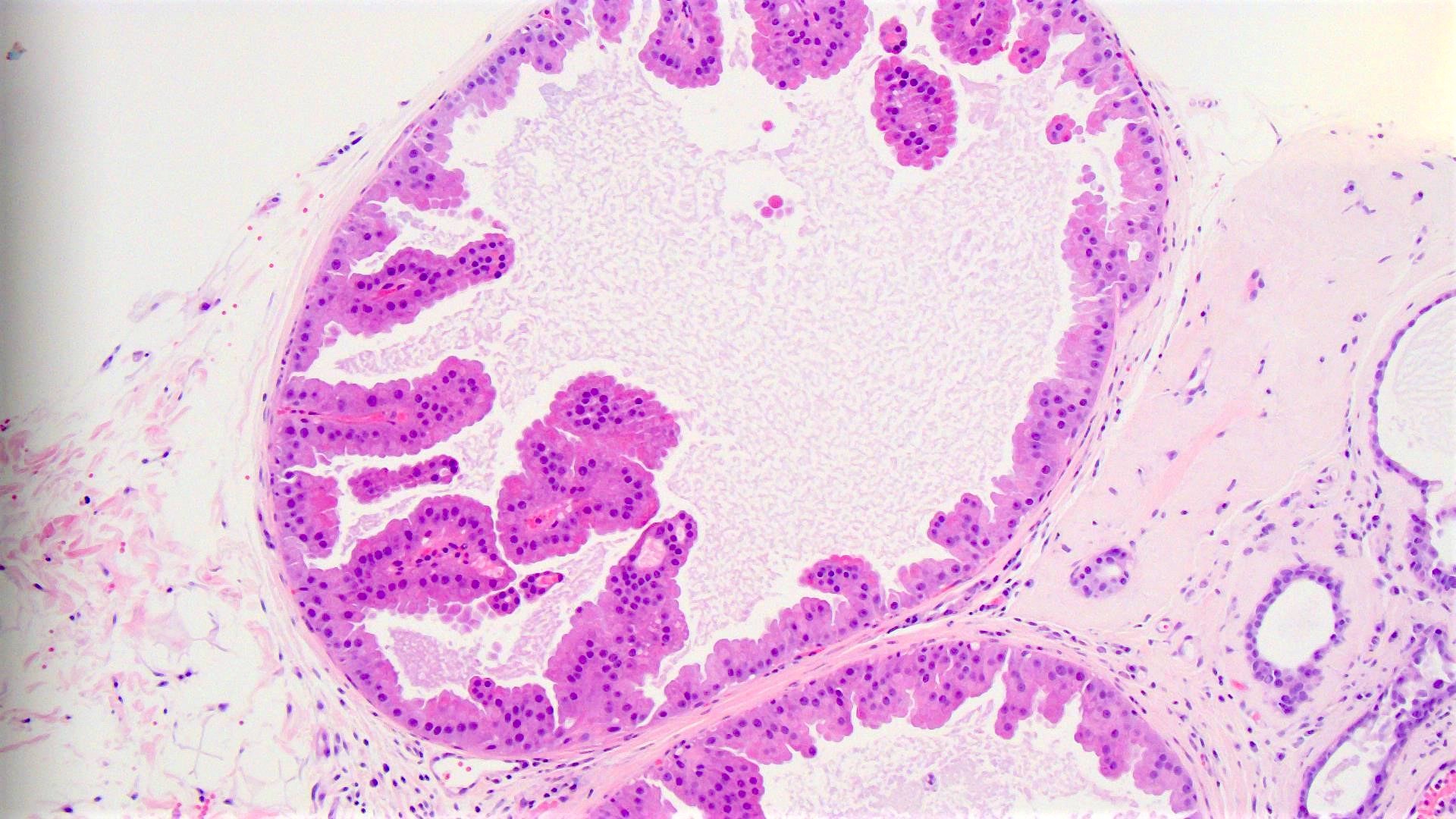 Intraductal papilloma with apocrine atypia