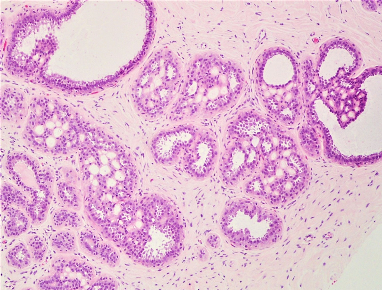 A húgyhólyag papilláris urotheliális karcinóma - Papilláris urothelialis hyperplasia hólyag