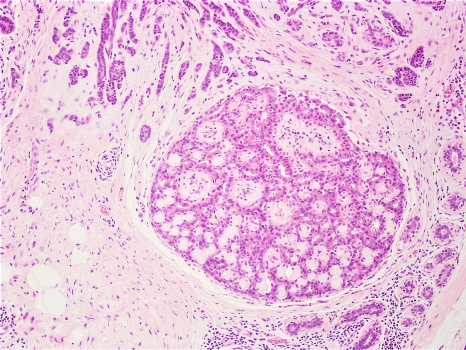 papilláris urothelialis hyperplasia szövettan