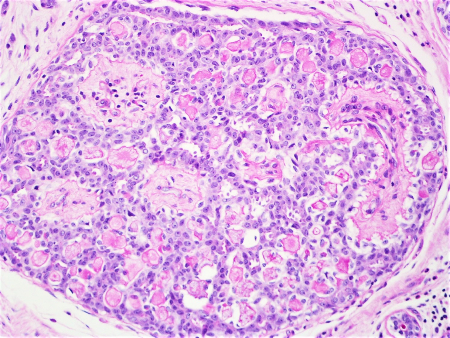 Papilláris urothelialis hyperplasia hólyag. A húgyhólyag papilláris urotheliális karcinóma