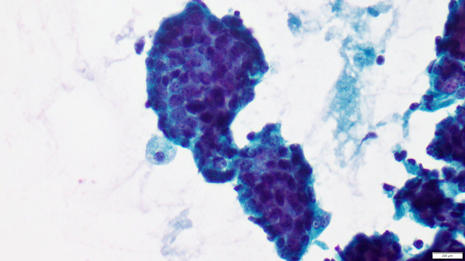 ductal papilloma cytology