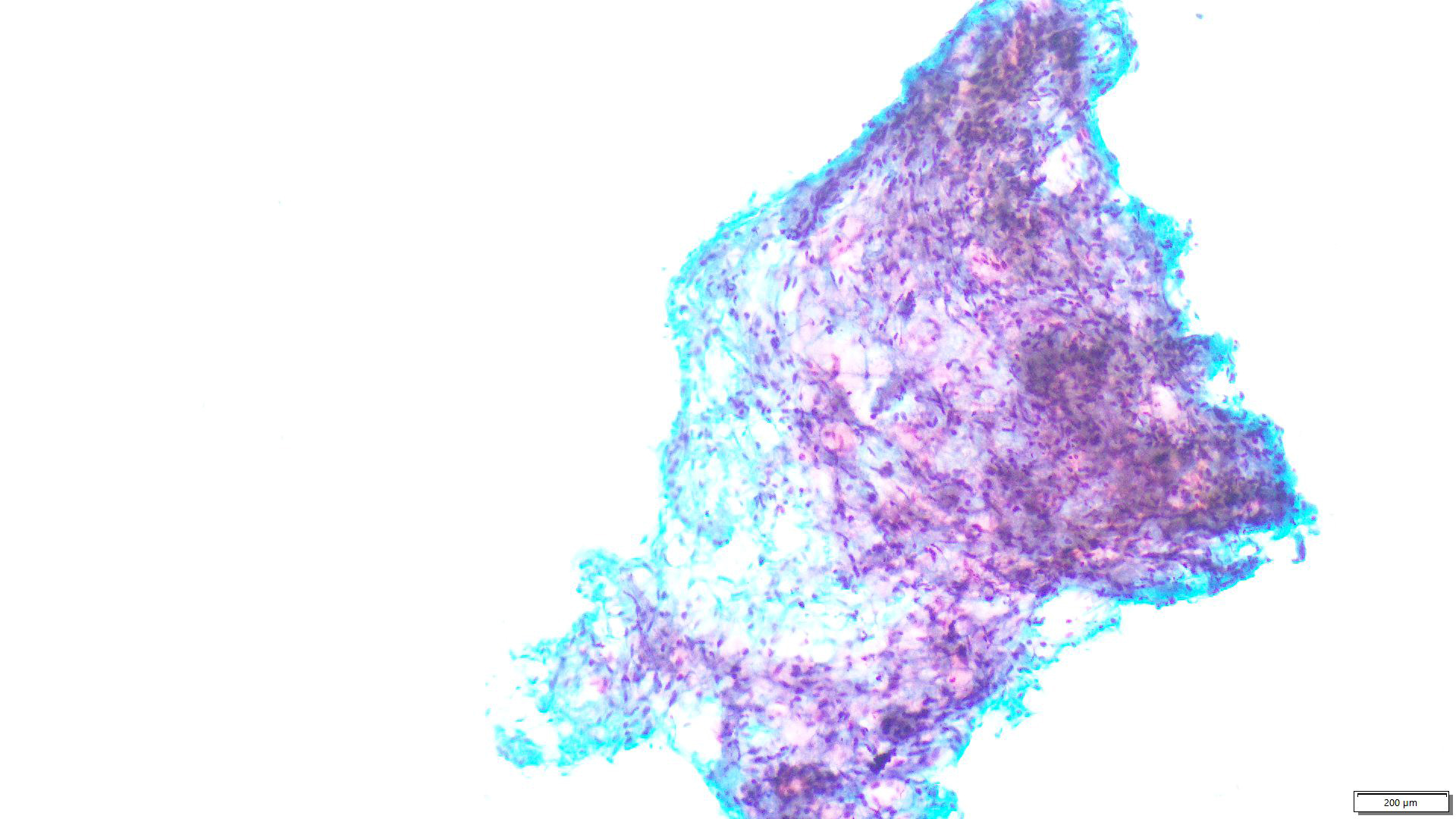 Phyllodes tumor (C2 / C3)