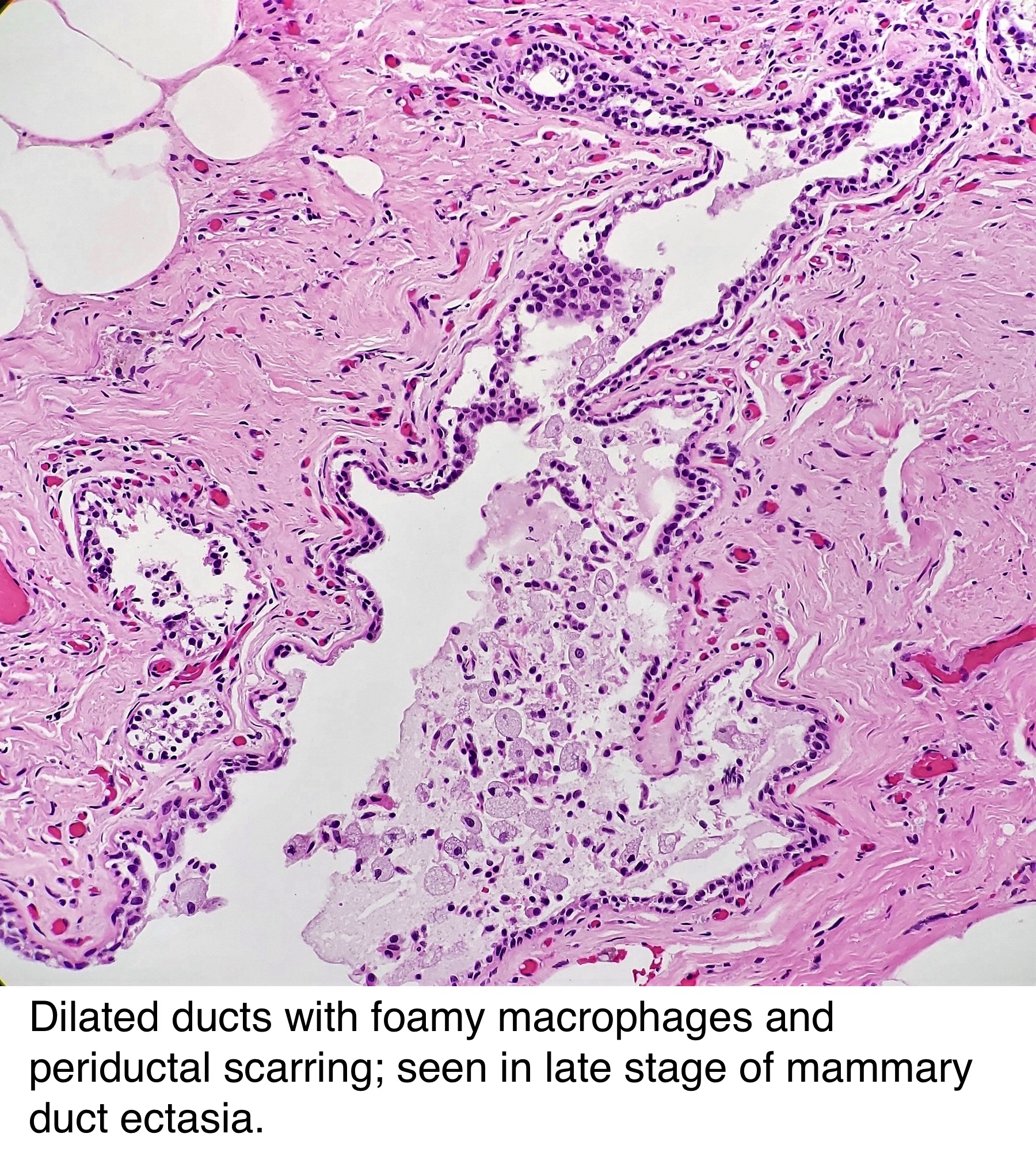 Pathology Outlines Duct Ectasia