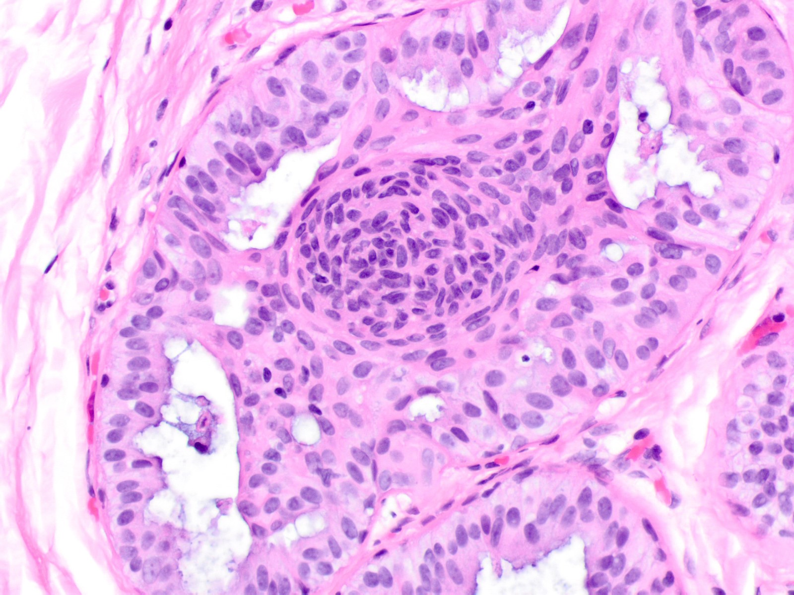 breast hyperplasia Ductal epithelial