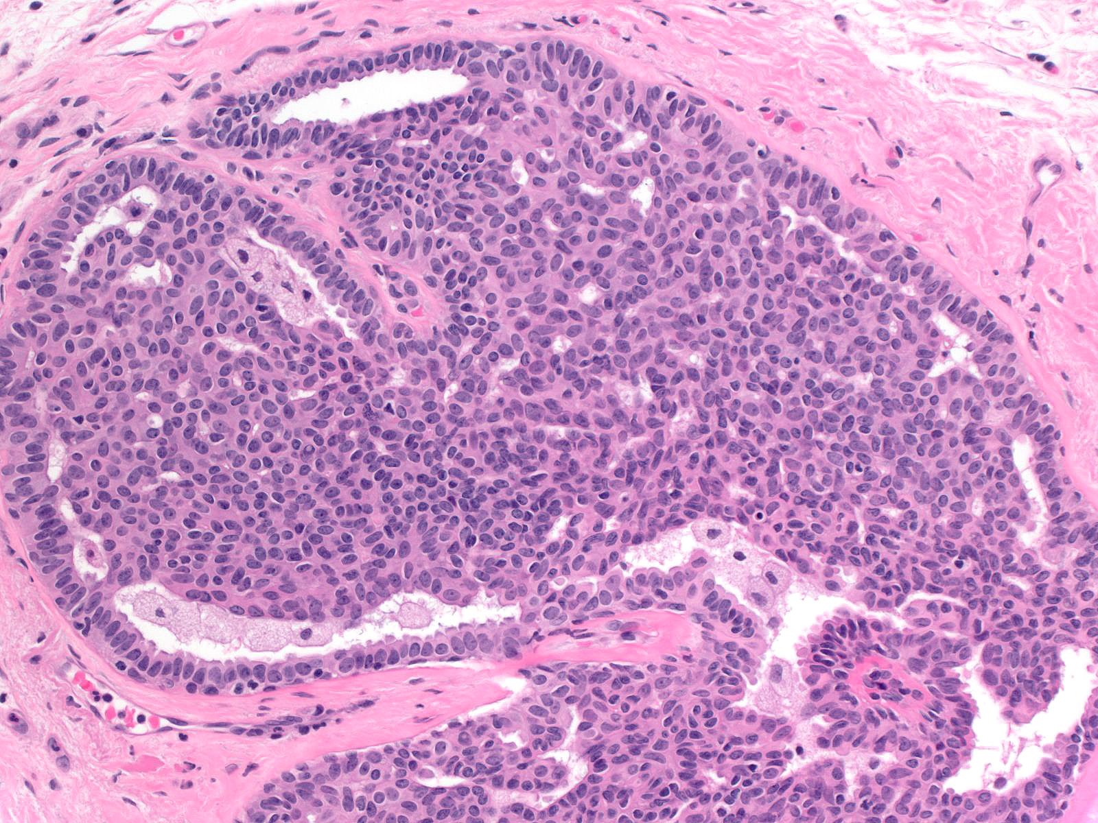 Intraductal papilloma with epithelial hyperplasia