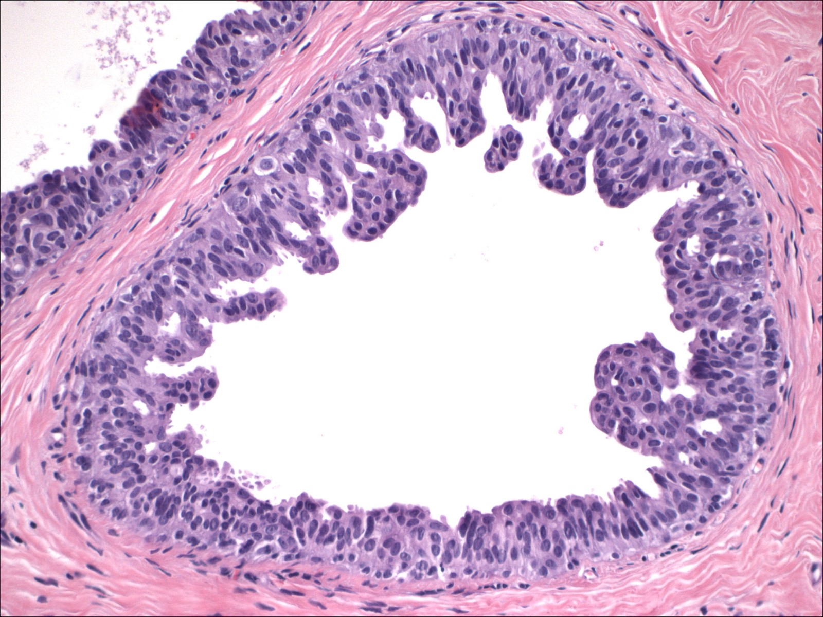 intraductal papilloma with florid hyperplasia