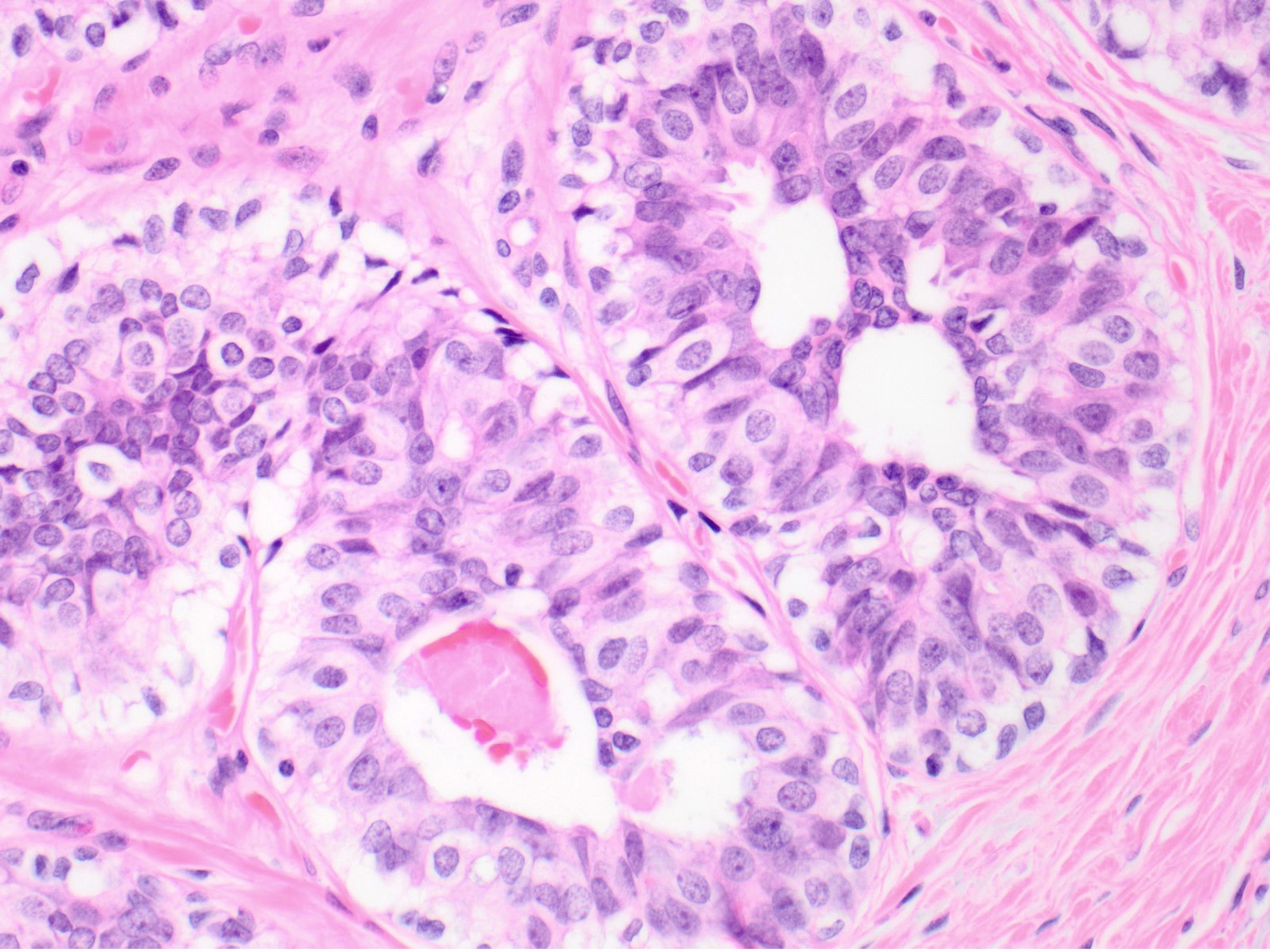 Intraductal papilloma ductal hyperplasia Intraductal papilloma with florid usual ductal hyperplasia