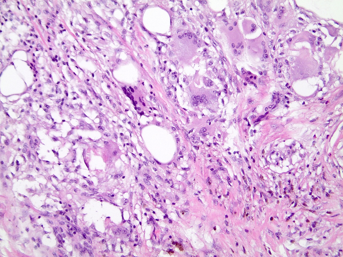 Multinucleated giant cells