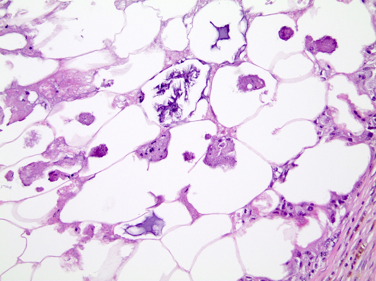 Necrotic adipocytes