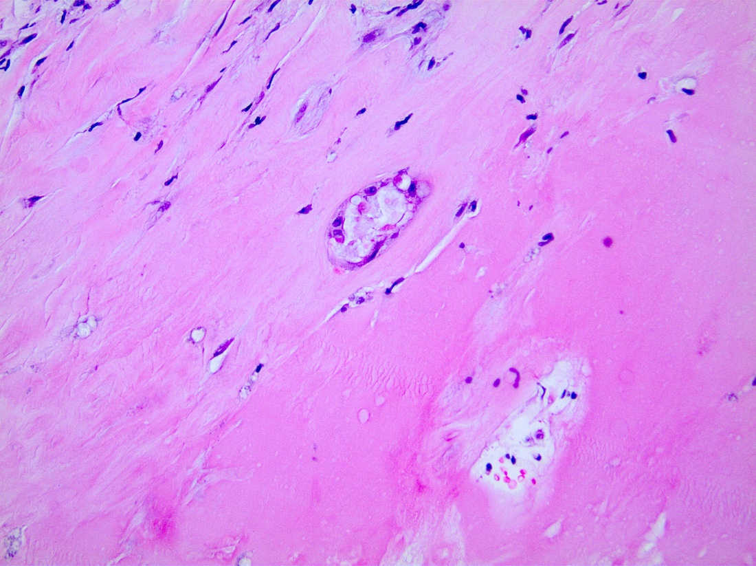 Late stage fibrosis