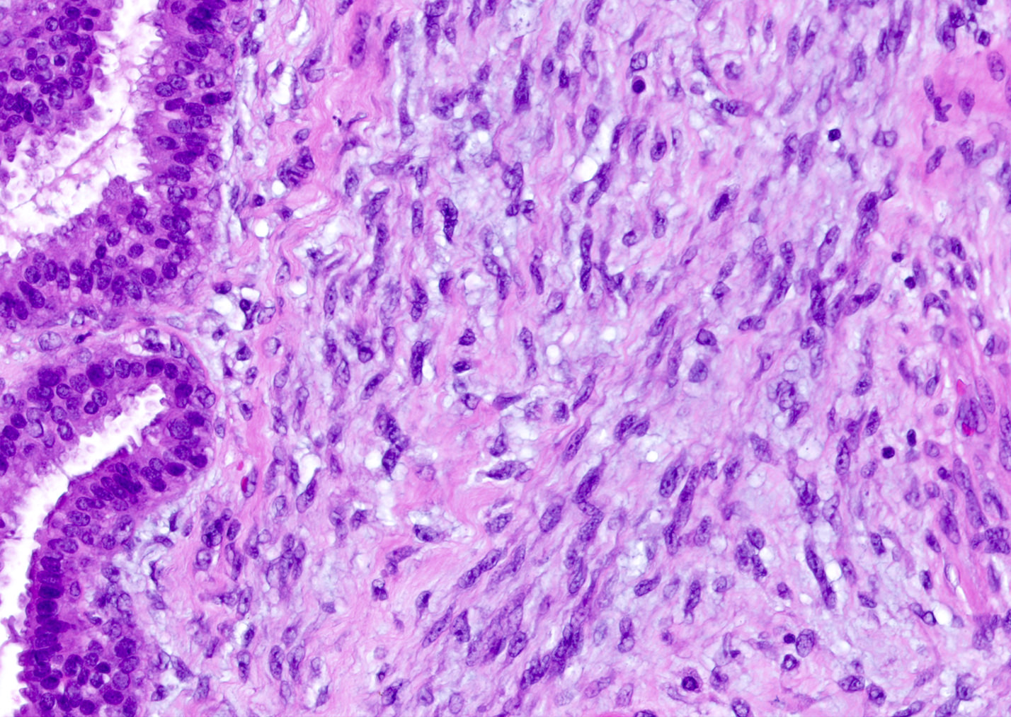 Cellular fibroadenoma 