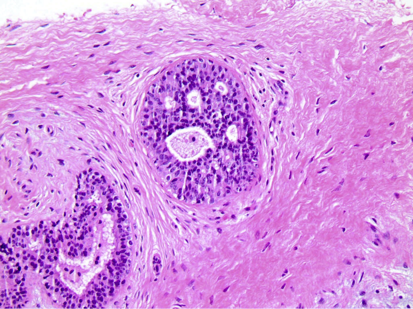 Pathology Outlines Fibroadenoma