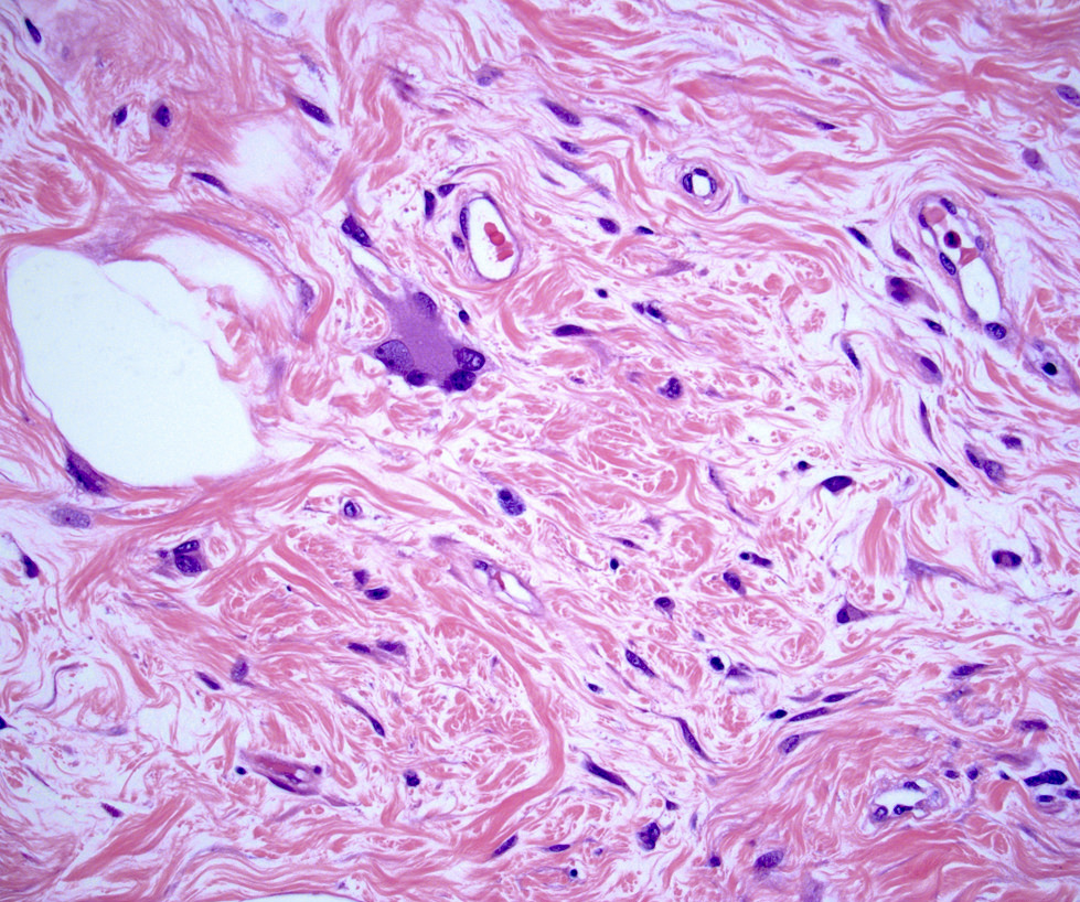 Multinucleated stromal cells.