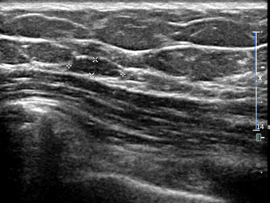 Cavernous hemangioma ultrasound