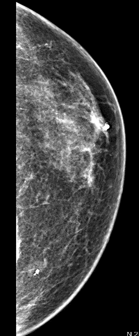 Cavernous hemangioma mammographic