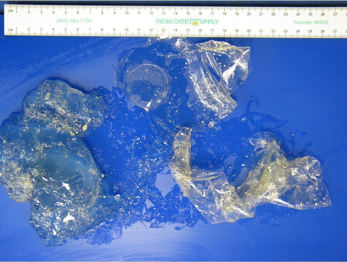 Ruptured silicone breast implants