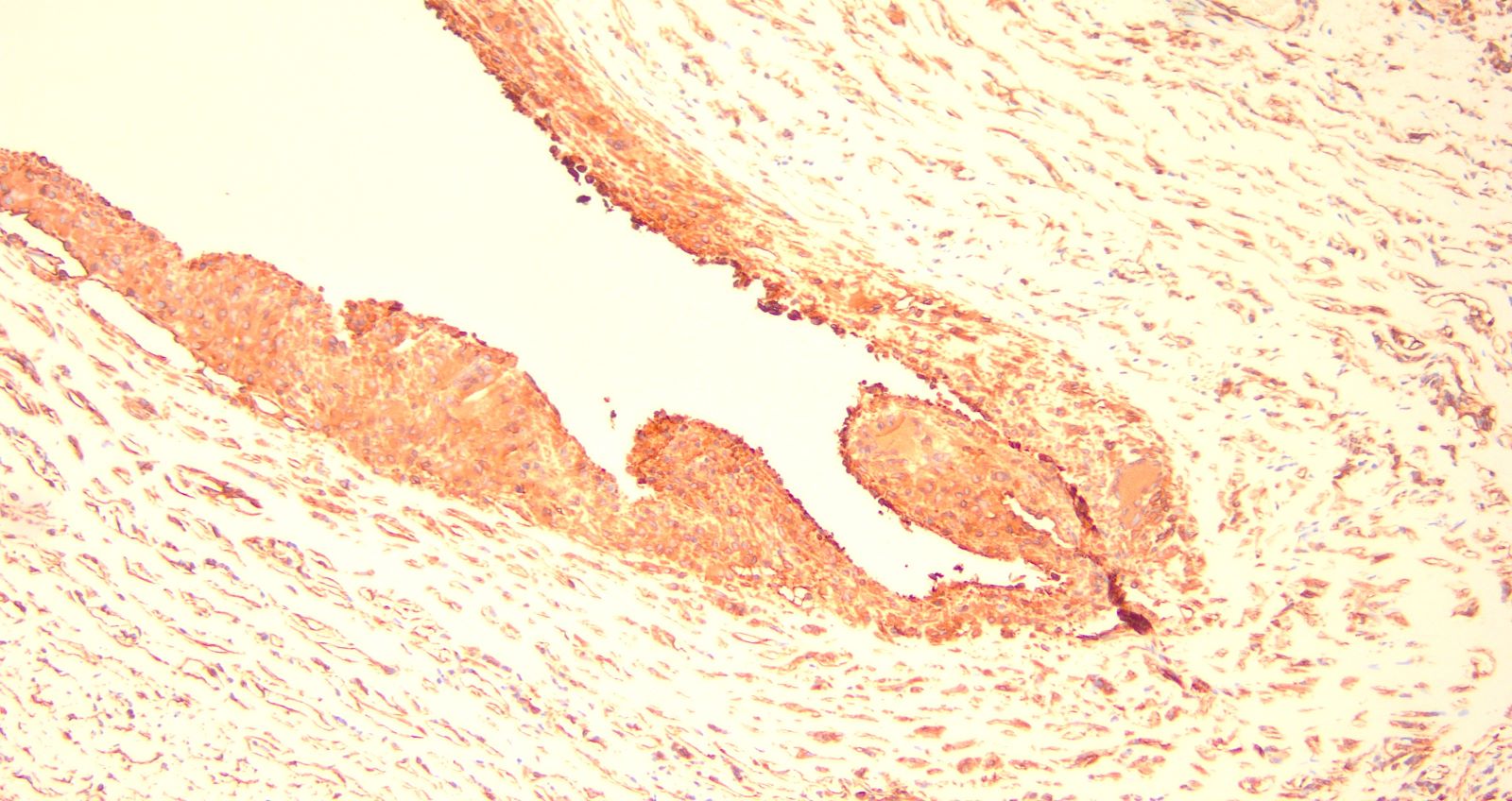 Synovial metaplasia vimentin