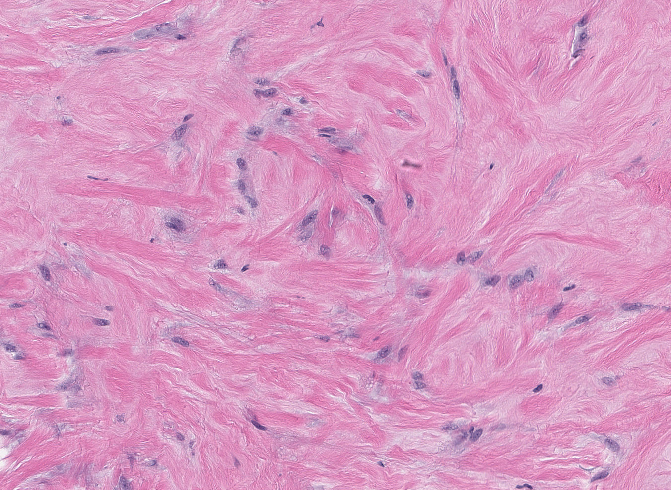 Epithelioid myofibroblasts