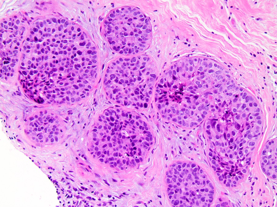 intraductal papilloma with dcis pathology outlines mik a szemölcsök