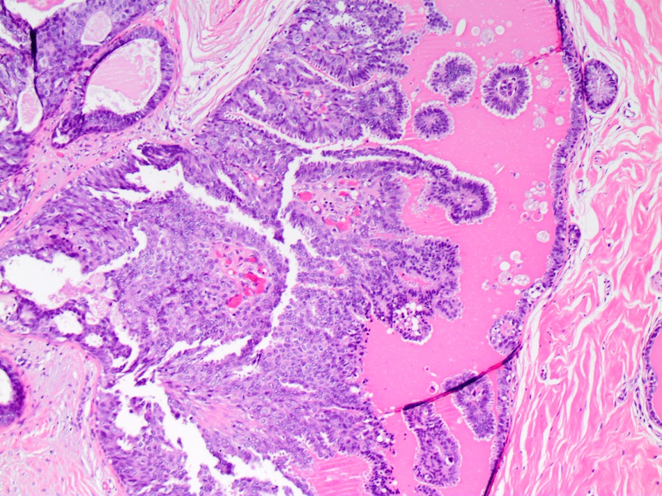 intraductal papilloma with dcis pathology outlines