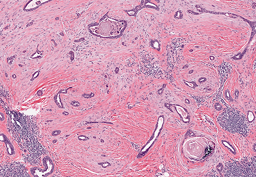 Glands and squamous nests