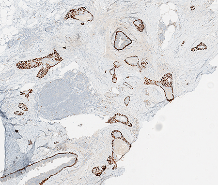 p63: variable myoepithelial staining