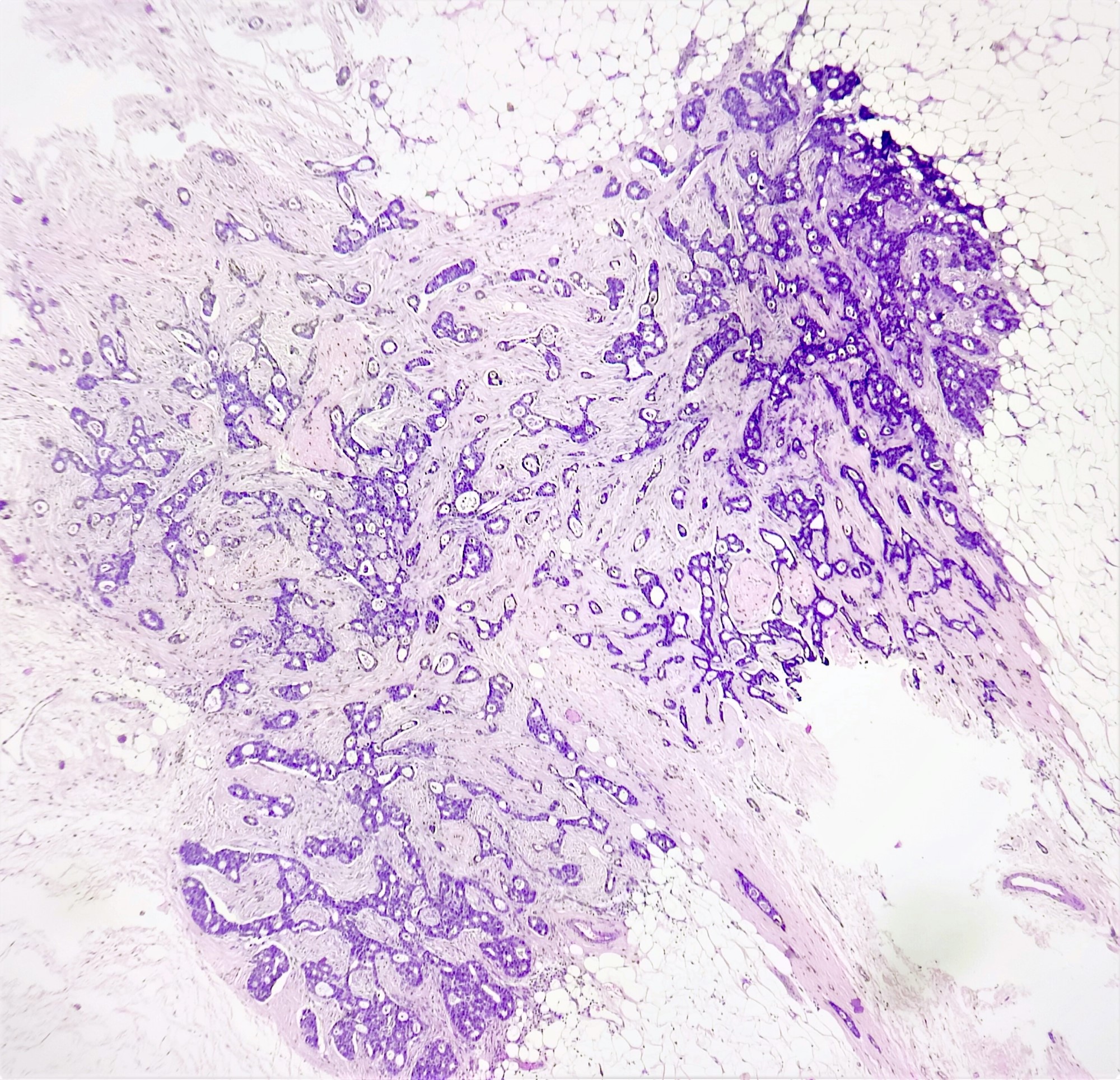 Invasive cribriform carcinoma