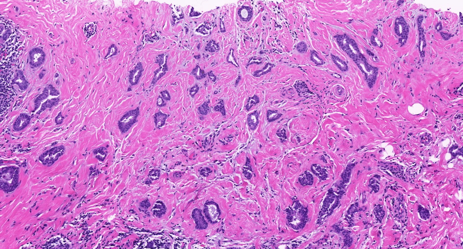 Pathology Outlines Invasive Breast Cancer Of No Special Type Nst