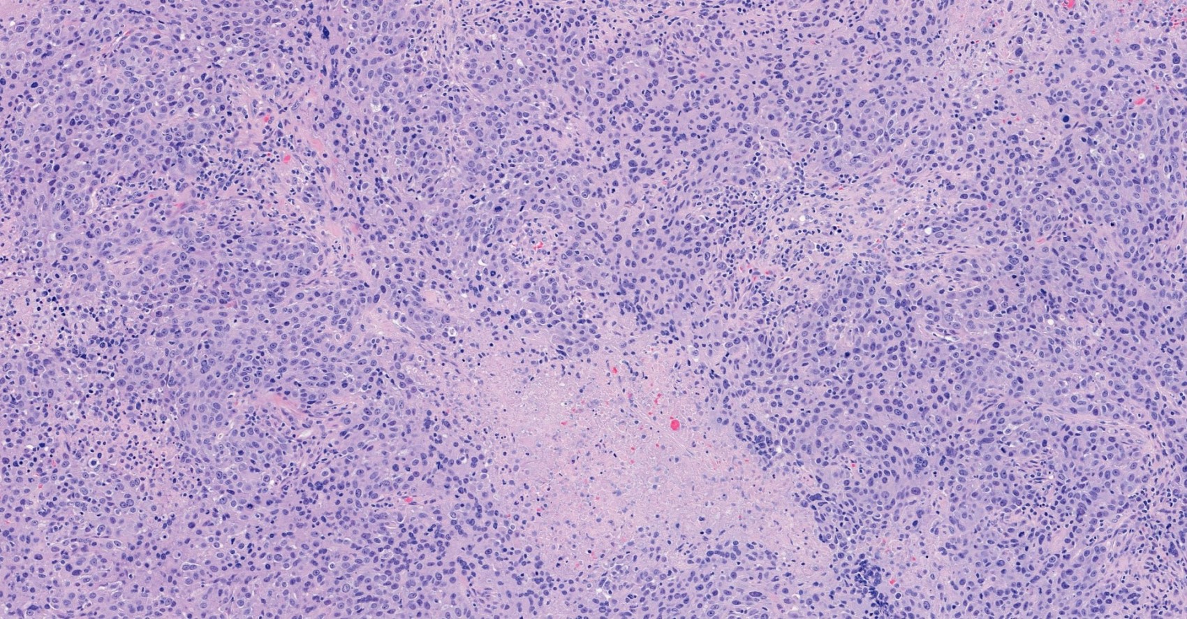 Invasive ductal carcinoma with necrosis, grade 3