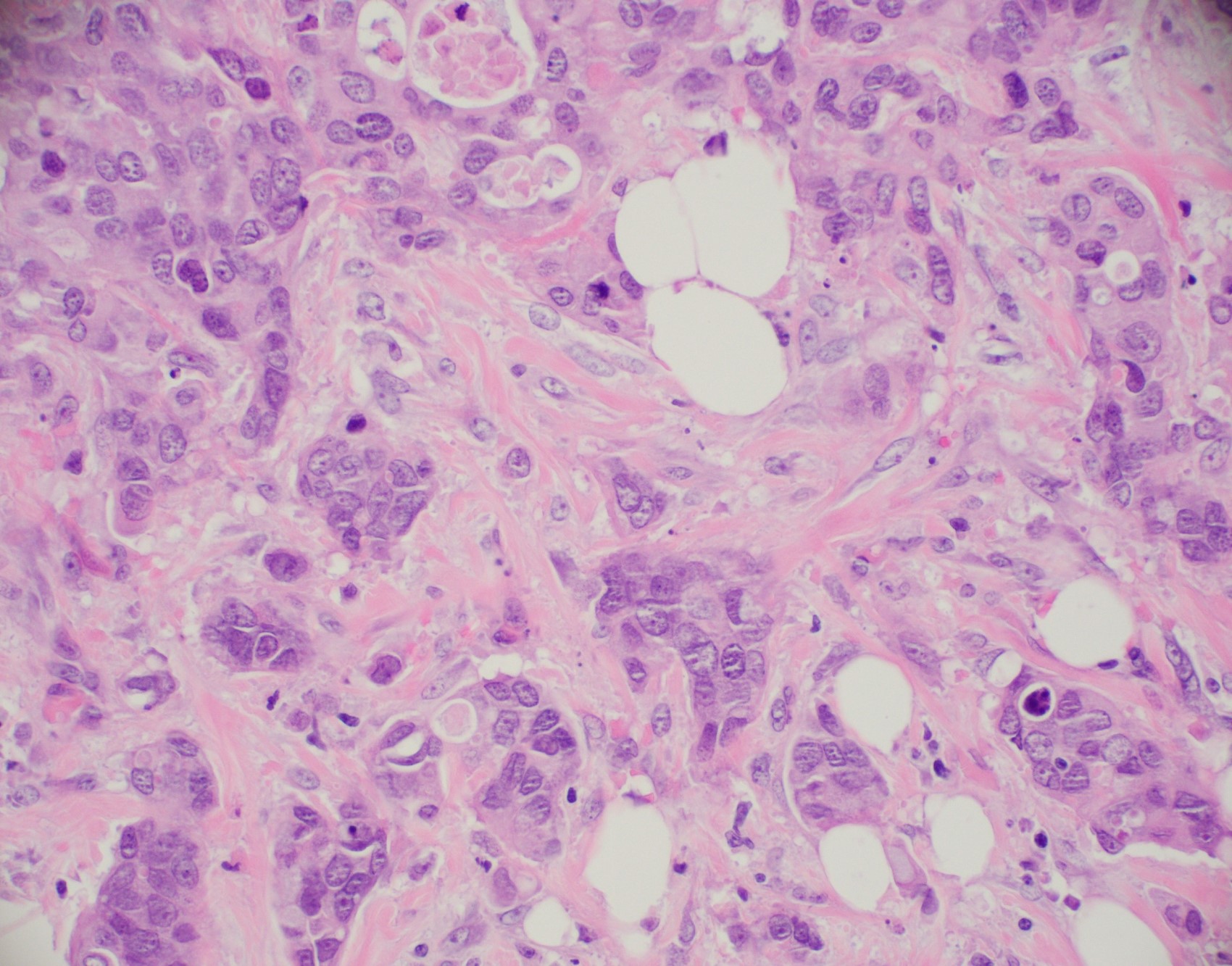 Invasive ductal carcinoma with scattered apoptotic cells