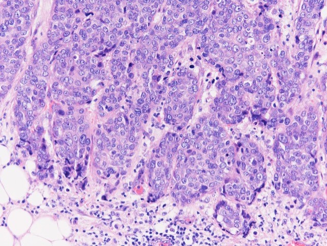 Invasive ductal carcinoma, grade 3