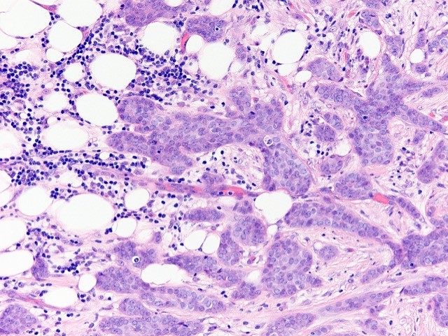 Invasive ductal carcinoma, grade 2