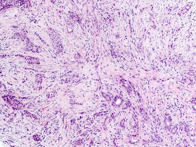 Invasive ductal carcinoma, grade 2