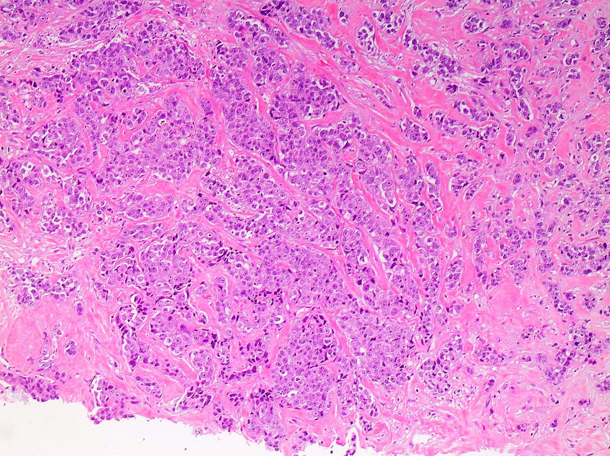 SOX10 positive invasive ductal carcinoma