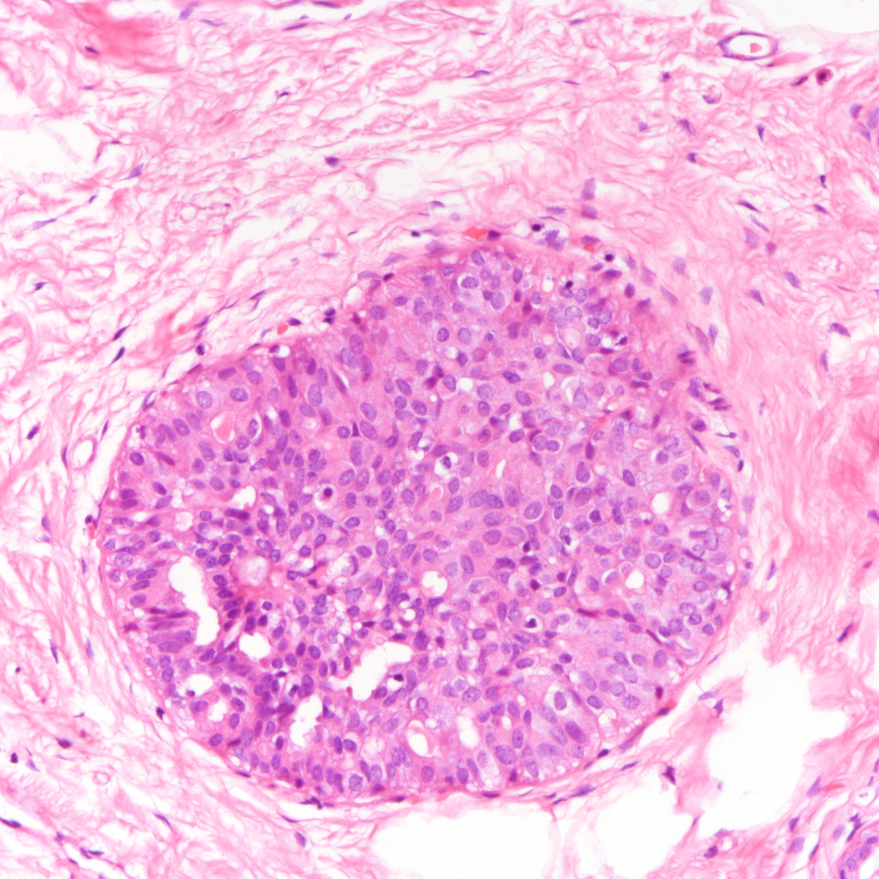 Atypical ductal hyperplasia