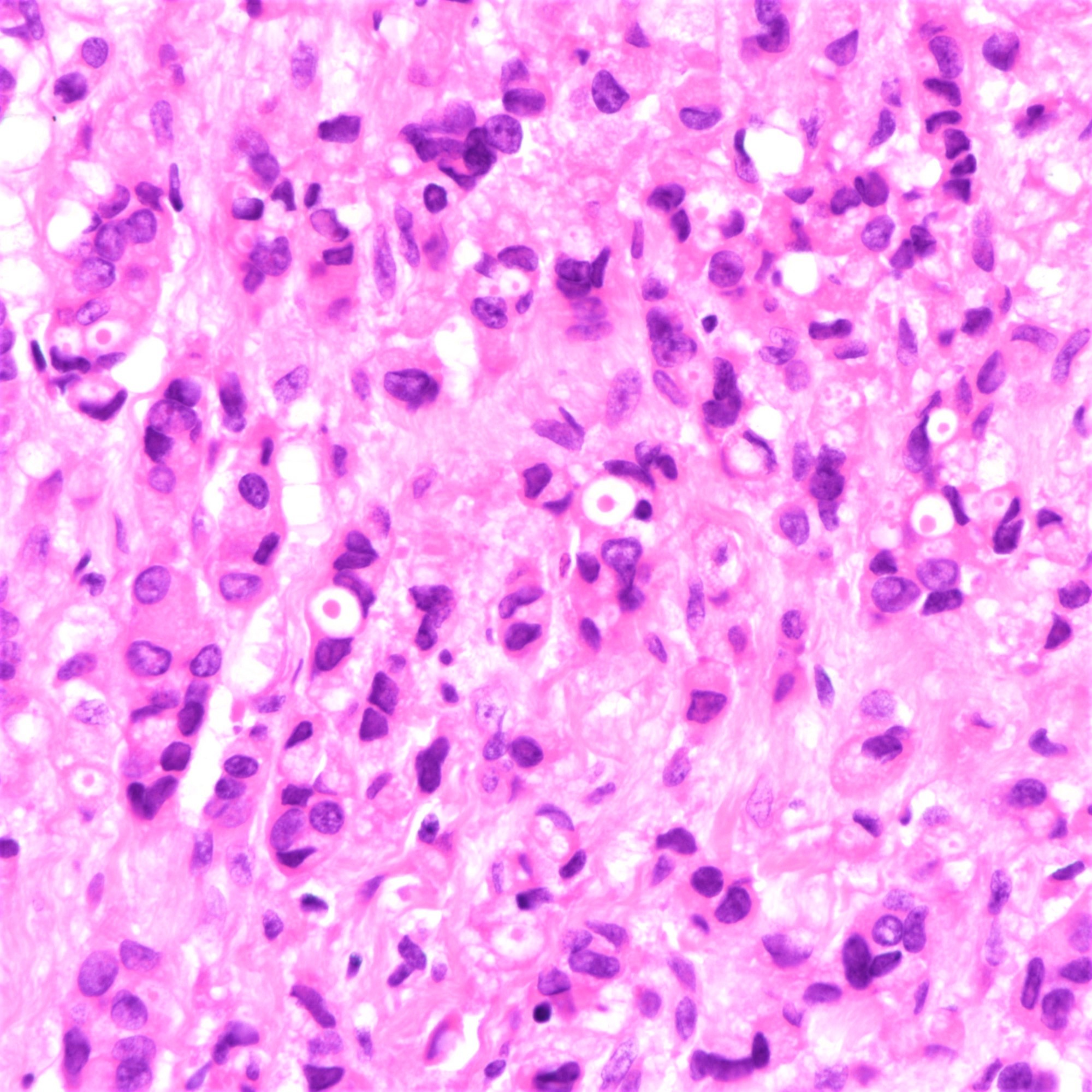 Intracytoplasmic vacuoles