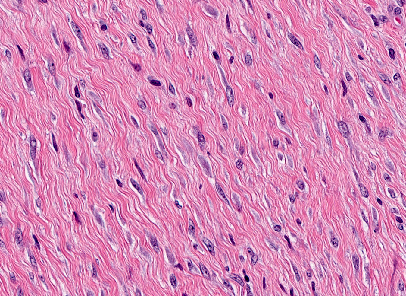 Bland spindle cells