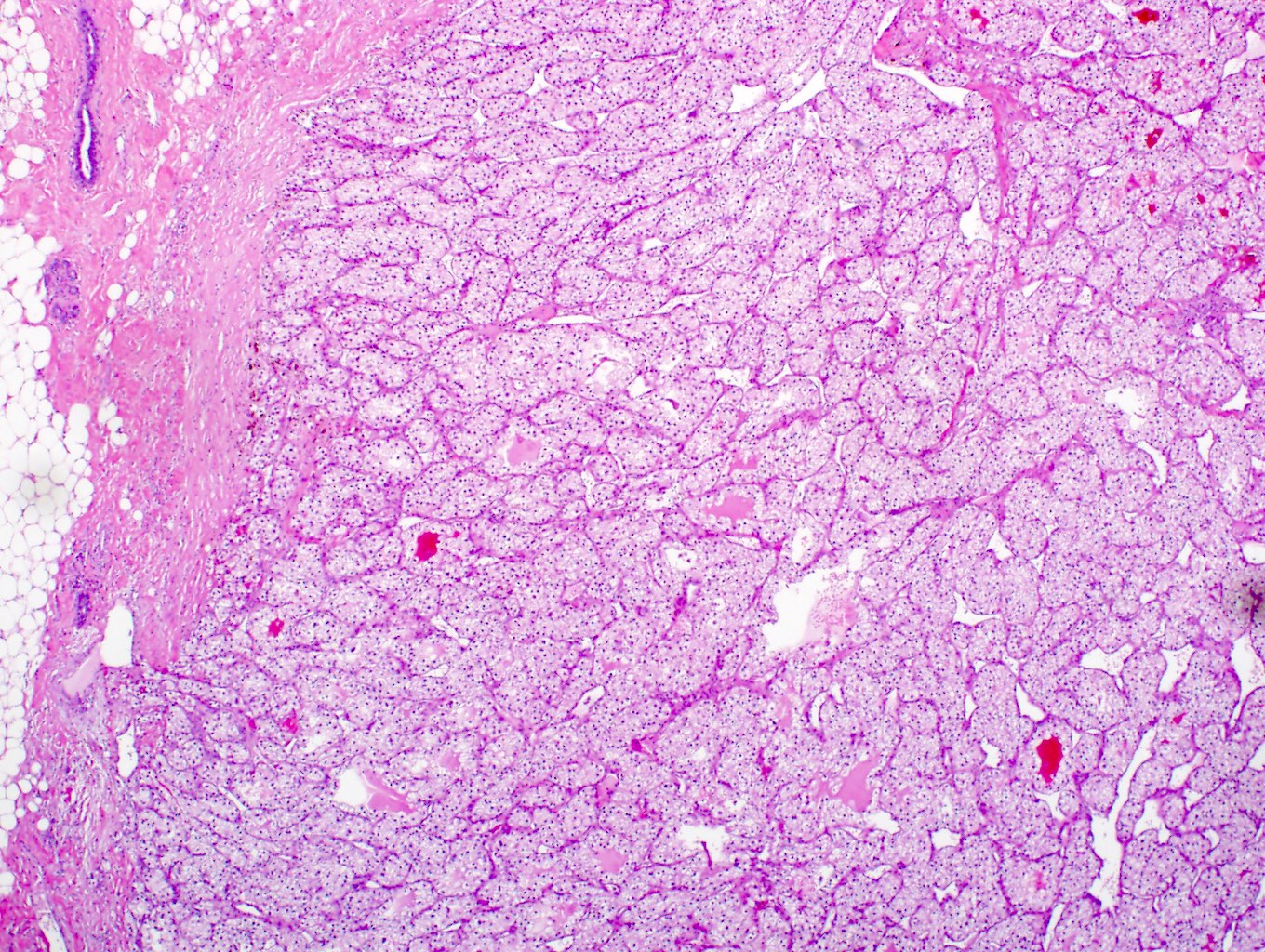 Metastatic clear cell renal cell carcinoma